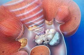 Illustration for article titled Obat Penghancur Batu Ginjal Yang Bagus